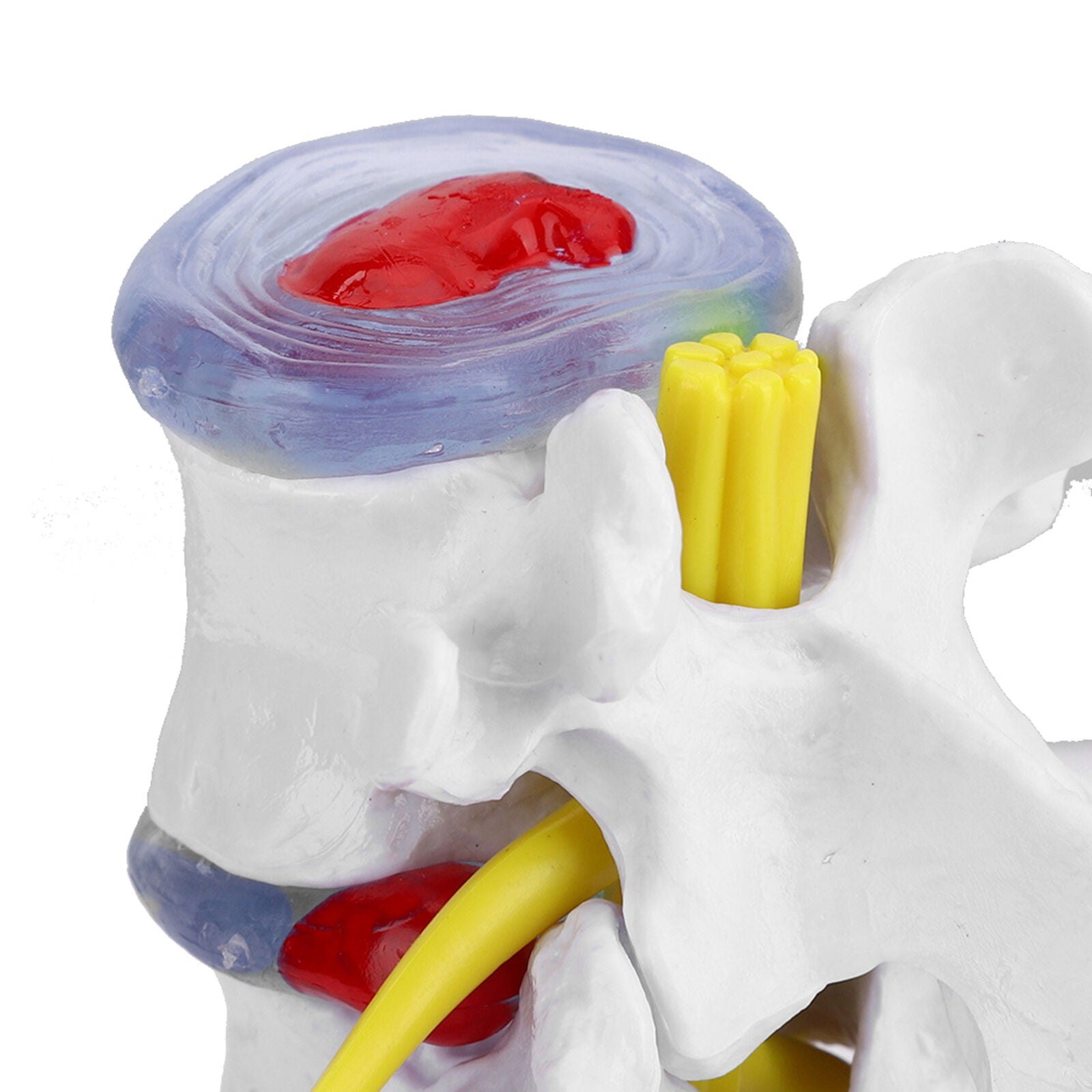 new Anatomical Lumbar Disc Herniation Demonstration Model Human Spine School US koeek - KOEEK