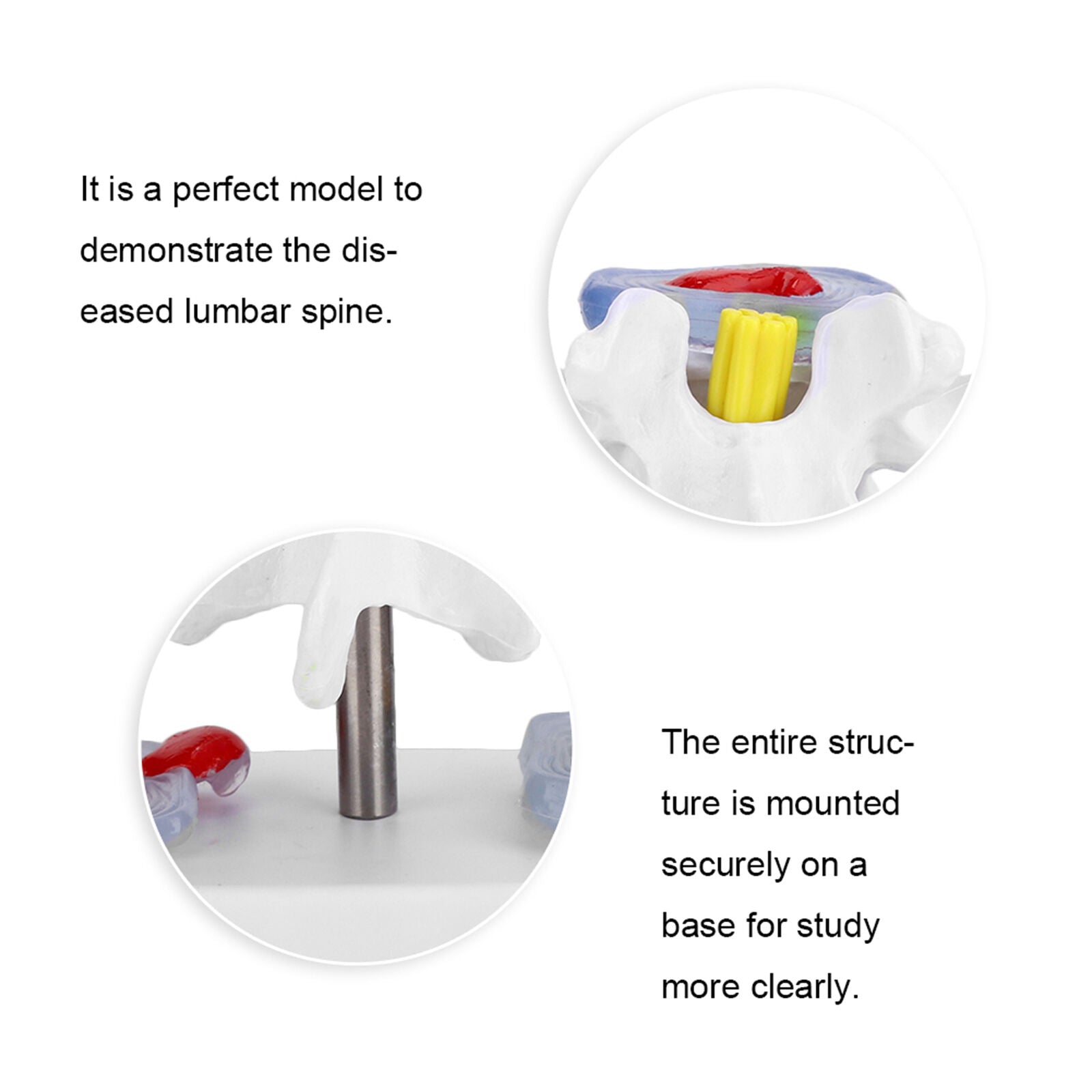 new Anatomical Lumbar Disc Herniation Demonstration Model Human Spine School A koeek - KOEEK