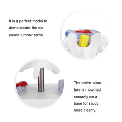 new Anatomical Lumbar Disc Herniation Demonstration Model Human Spine School A koeek - KOEEK