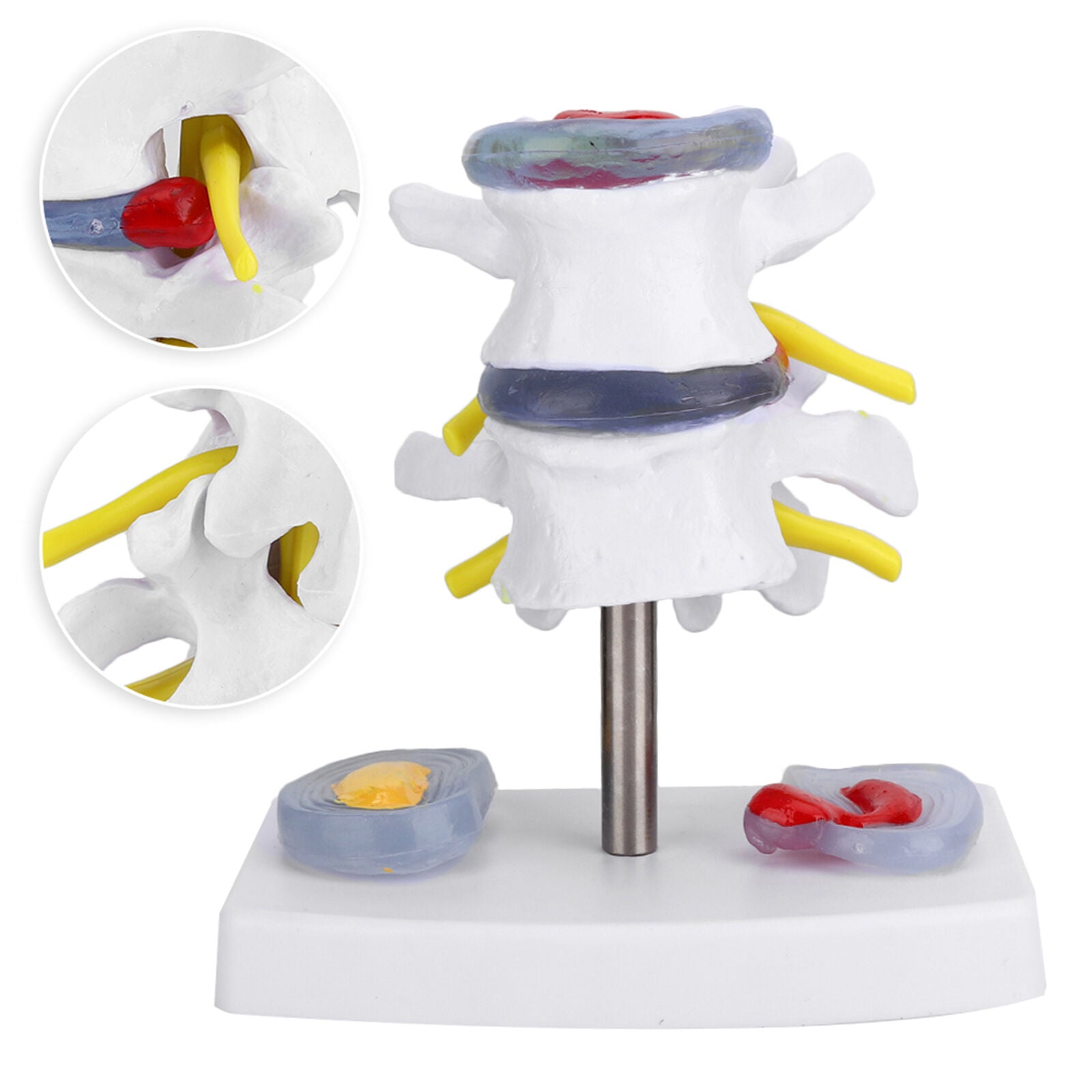 new Anatomical Lumbar Disc Herniation Demonstration Model Human Spine School koeek - KOEEK