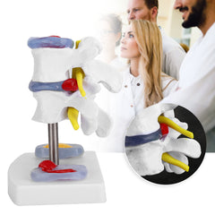 new Anatomical Lumbar Disc Herniation Demonstration Model Human Spine School US koeek - KOEEK