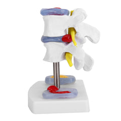 new Anatomical Lumbar Disc Herniation Demonstration Model Human Spine School A koeek - KOEEK