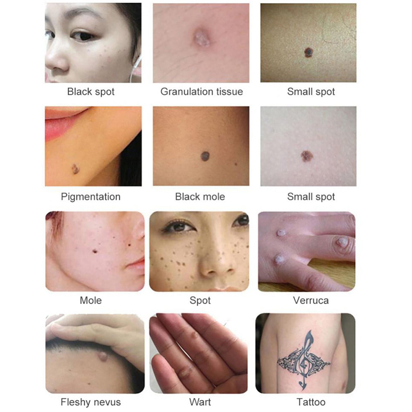 ny Ultralydspotfjernelsespen Stor Power Freckle Mole Removing Home Spa