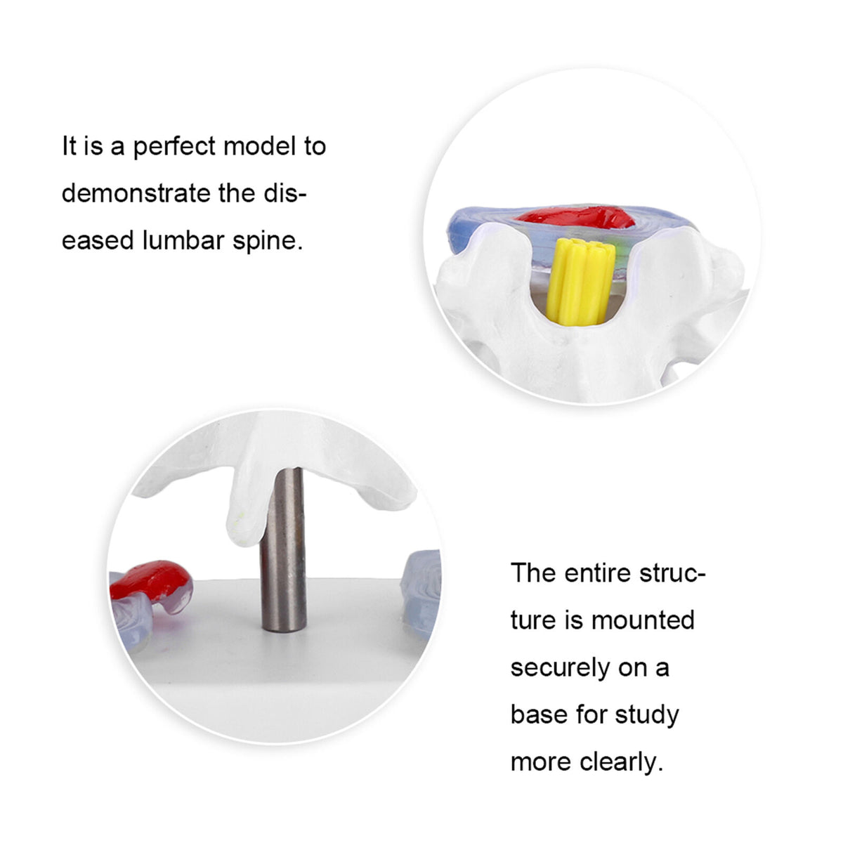 new Anatomical Lumbar Disc Herniation Demonstration Model Human Spine School US koeek - KOEEK