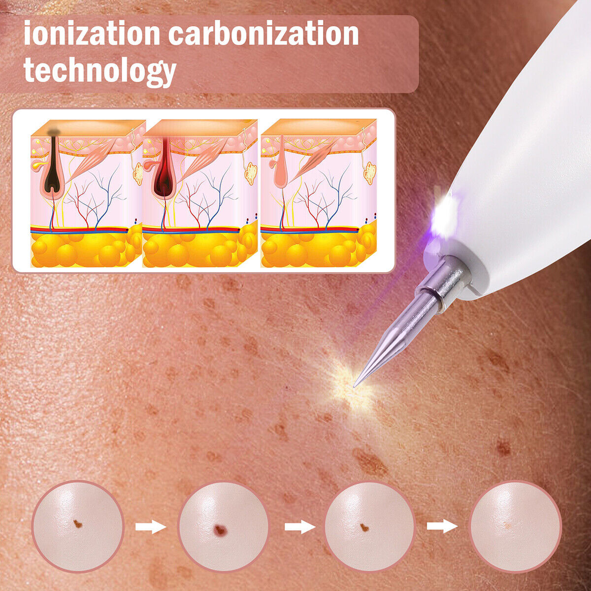 ny Laser Eliminador De Verrugas Removedor De Berrugas for Quitar Pecas y Topos