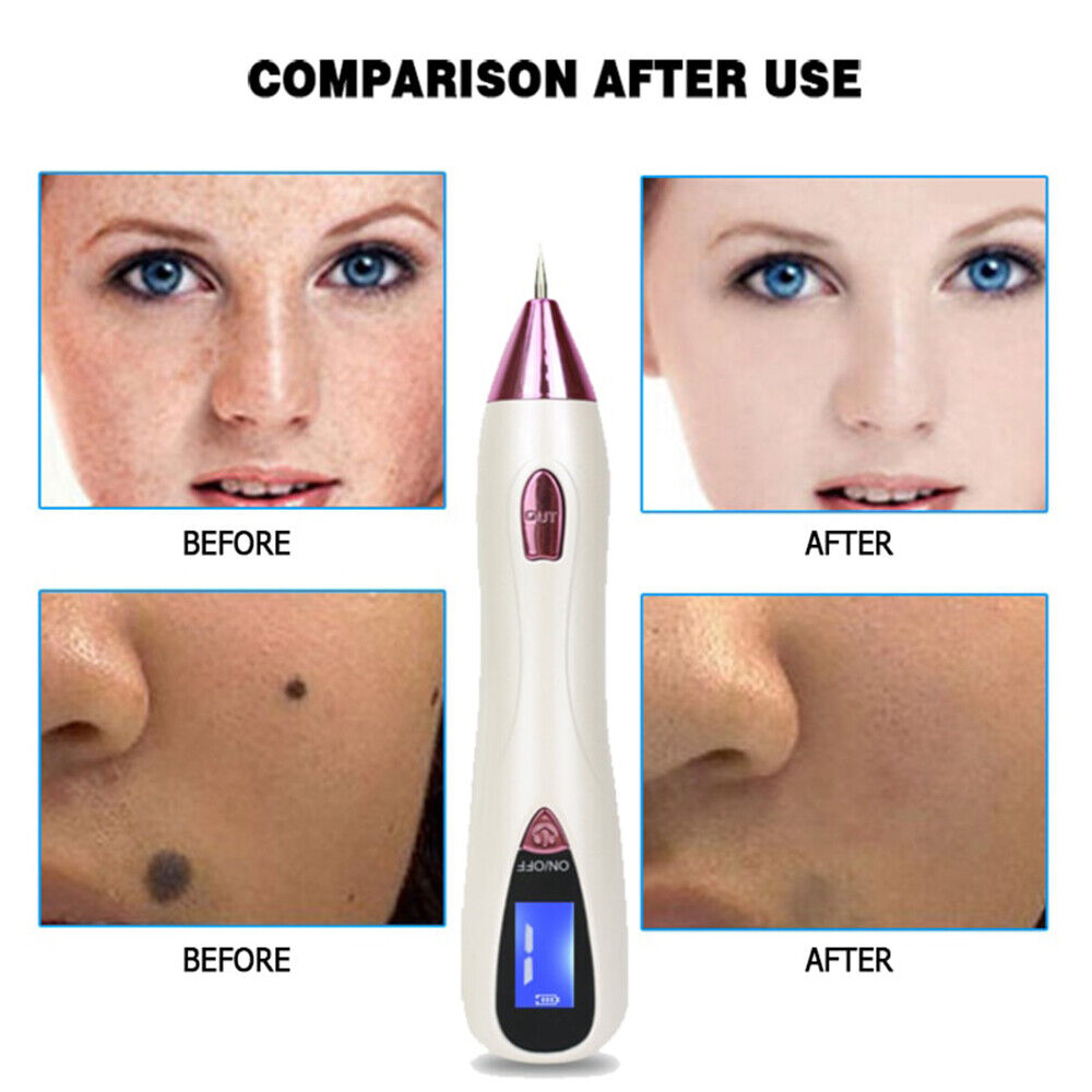 ny Electrico Laser Verrugas Quita Remover Pen Para Mezquinos Maquina Elimina Pecas