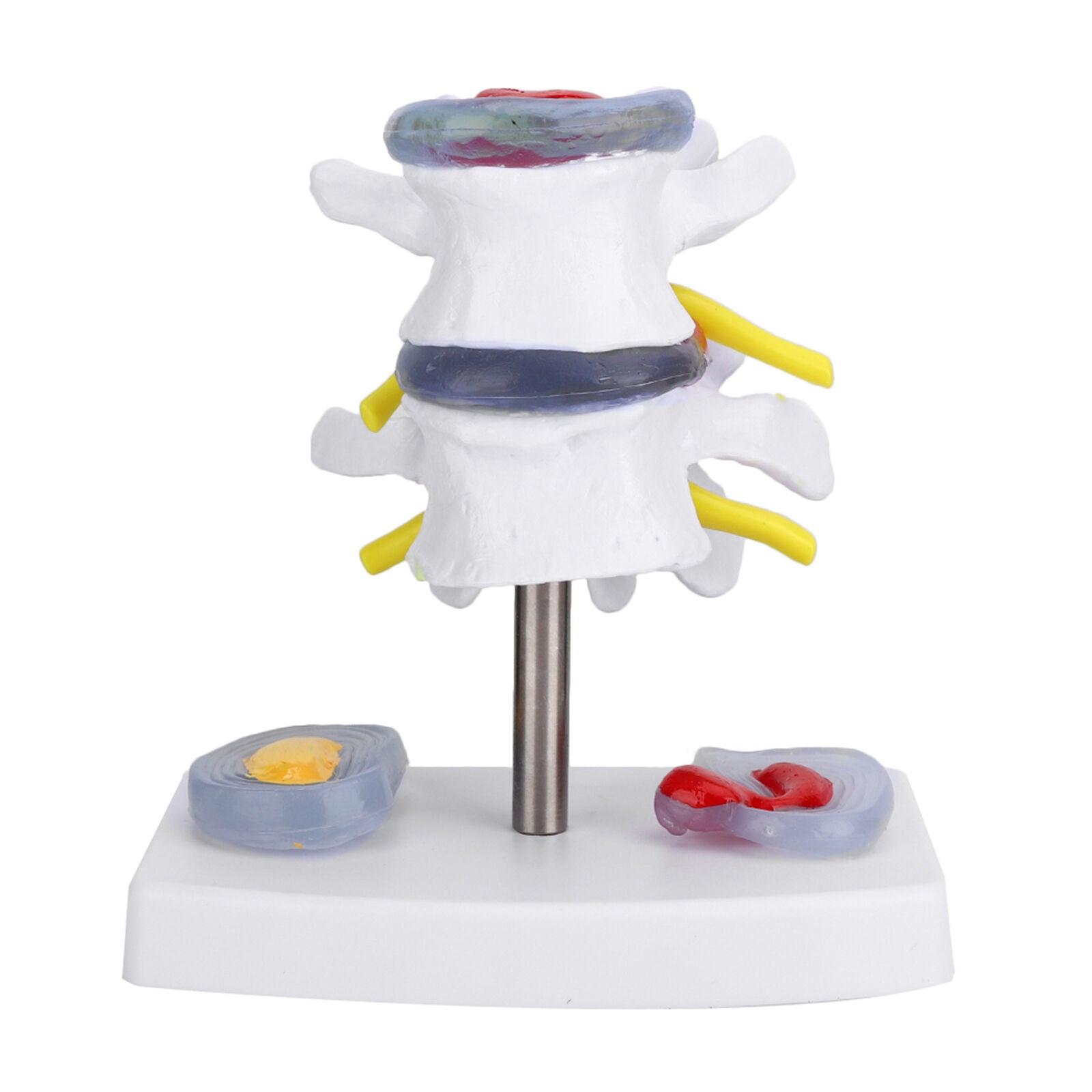 new Anatomical Lumbar Disc Herniation Demonstration Model Human Spine School US koeek - KOEEK