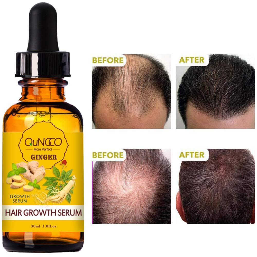 new 5 PACK Hair Growth Serum Liquid Loss Treatment for Women & Men Dense... 07FC0E-D4 - KOEEK