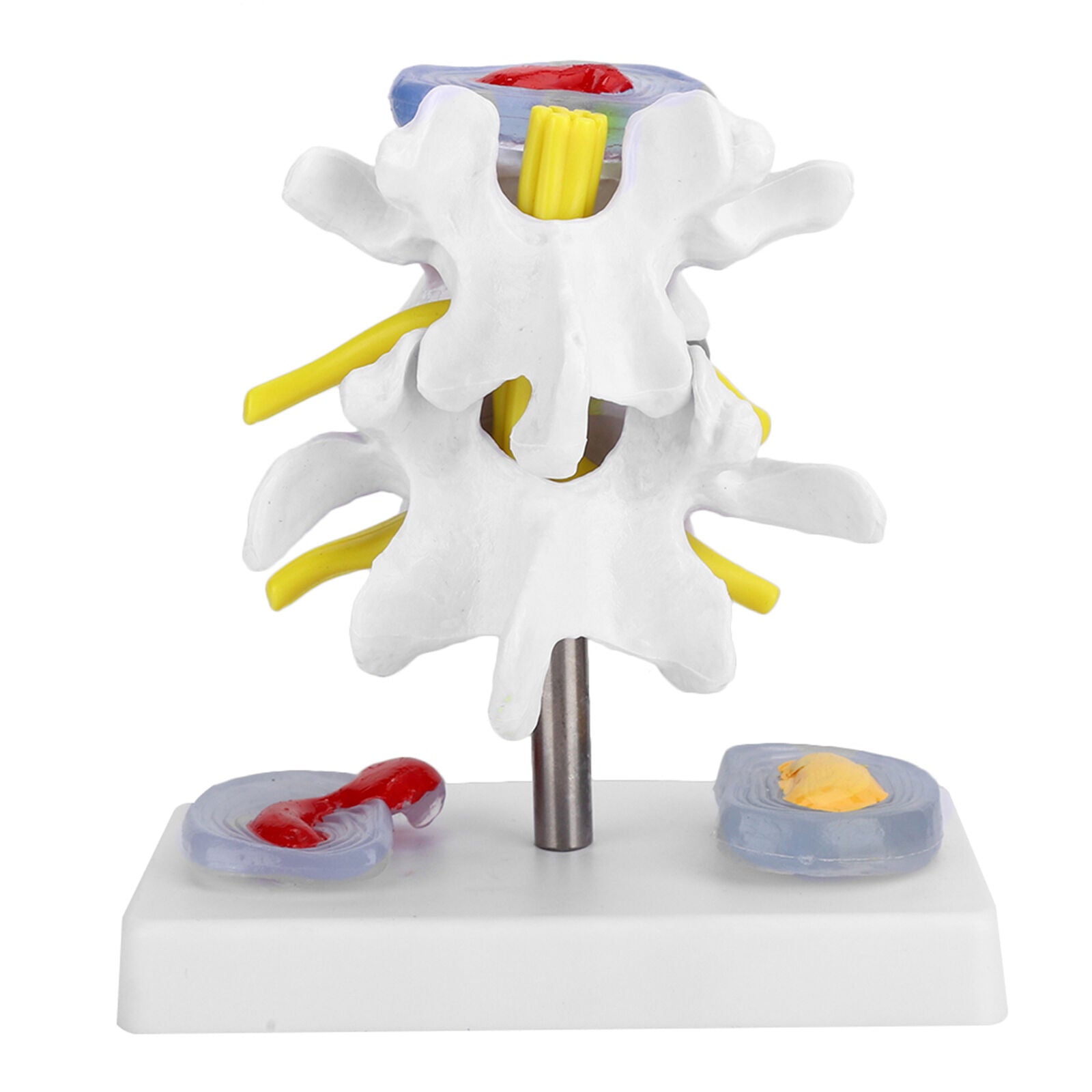 new Anatomical Lumbar Disc Herniation Demonstration Model Human Spine School US koeek - KOEEK